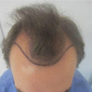 Resultado antes
