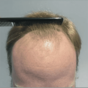 Línea frontal antes