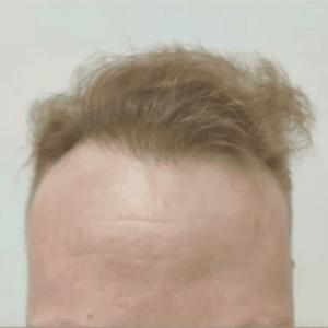 Línea frontal después