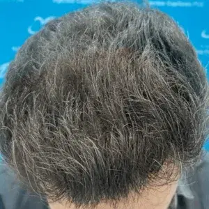 Densidad después