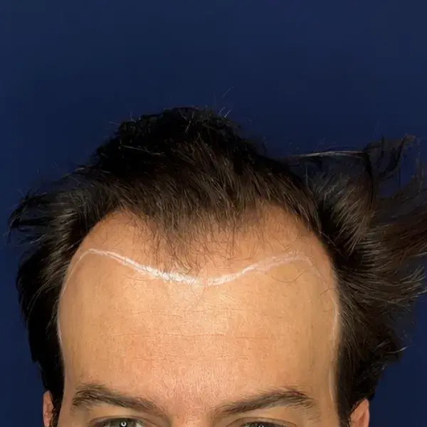 Frontal antes