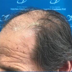 Perfil antes