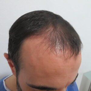 Caso 15 antes