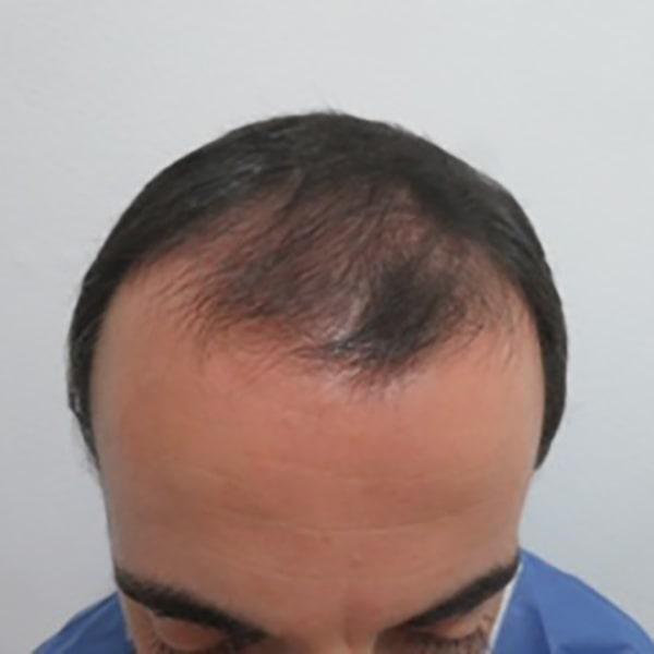 Caso 14 antes