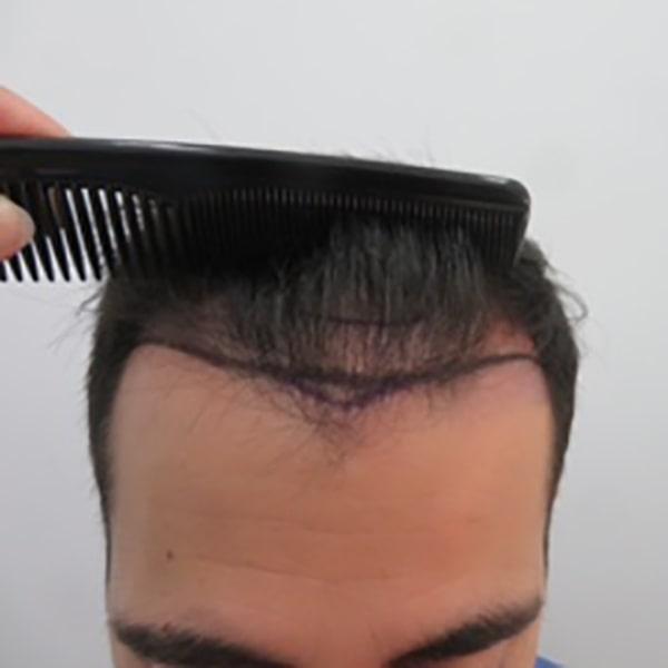Caso 12 antes