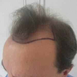 Resultado antes