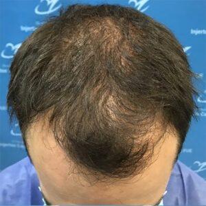 Resultado antes