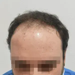 Caso 1 · Frontal antes