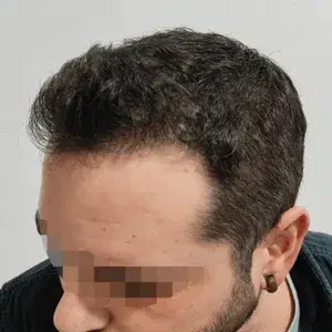 Caso 1 · Lateral después