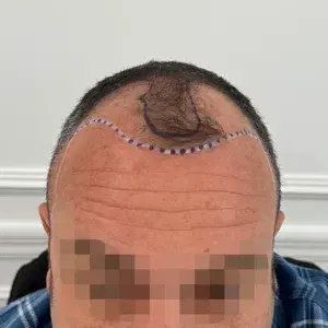 Caso 3 · Frontal antes