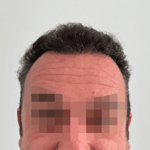Caso 3 · Frontal después