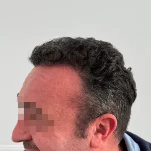 Caso 3 · Lateral después