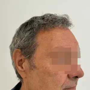 Caso 2 · Lateral después